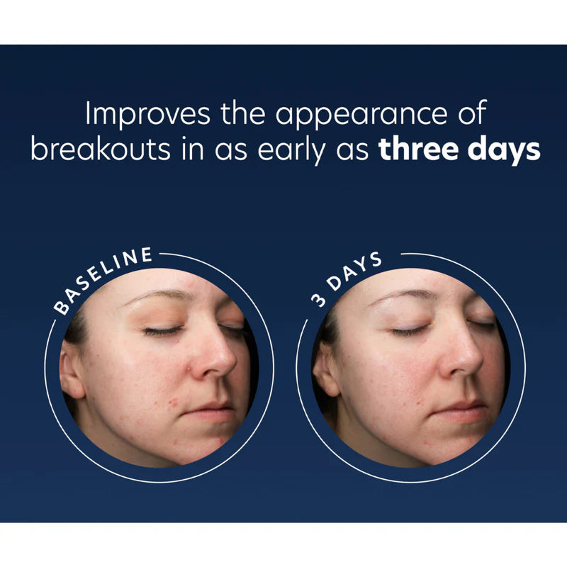 PCA Skin Blemish Control Bar