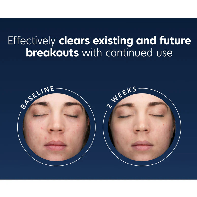 PCA Skin Acne Gel with OmniSome
